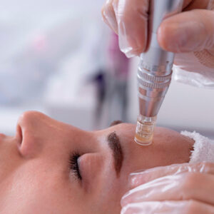 Microagulhamento facial